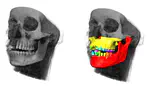 Automatic Bone and Tooth Detection for CT Based Dental Implant Planning