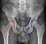 Automatic Quantification of Hip Osteoarthritis From Low Quality X-Ray Images