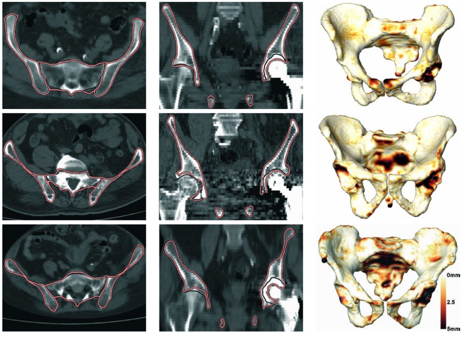 Automatic Segmentation Of The Pelvic Bones From Ct Data Based On A Statistical Shape Model 0910