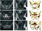 Automatic Segmentation of the Pelvic Bones From CT Data Based on a Statistical Shape Model