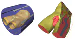From Image Data to Three Dimensional Models Case Studies on the Impact of 3D Patient Models