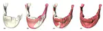 Reconstruction of Mandibular Dysplasia Using a Statistical 3D Shape Model
