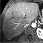 Registration of Different Phases of Contrast Enhanced MR Data for Liver Surgery