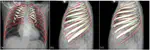 Towards Model Based 3-D Reconstruction of the Human Rib Cage From Radiographs